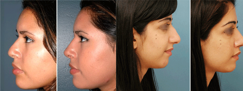 Rhinoplasty In Lahore Nose Reshaping Surgery In Pakistan