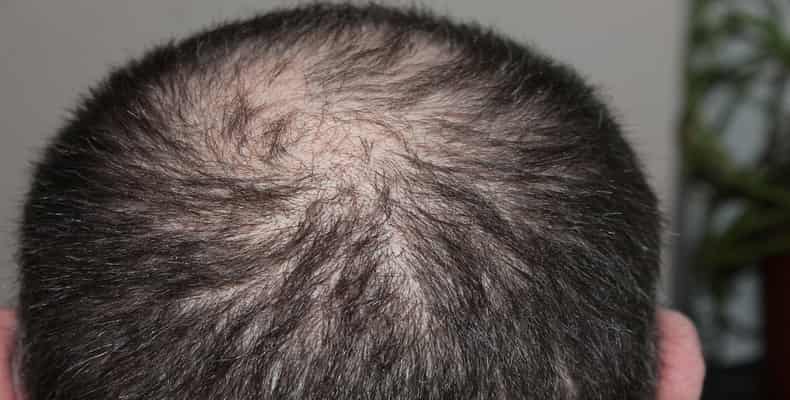 Why is My Hair Falling Out Male (Best Answer By Doctor)