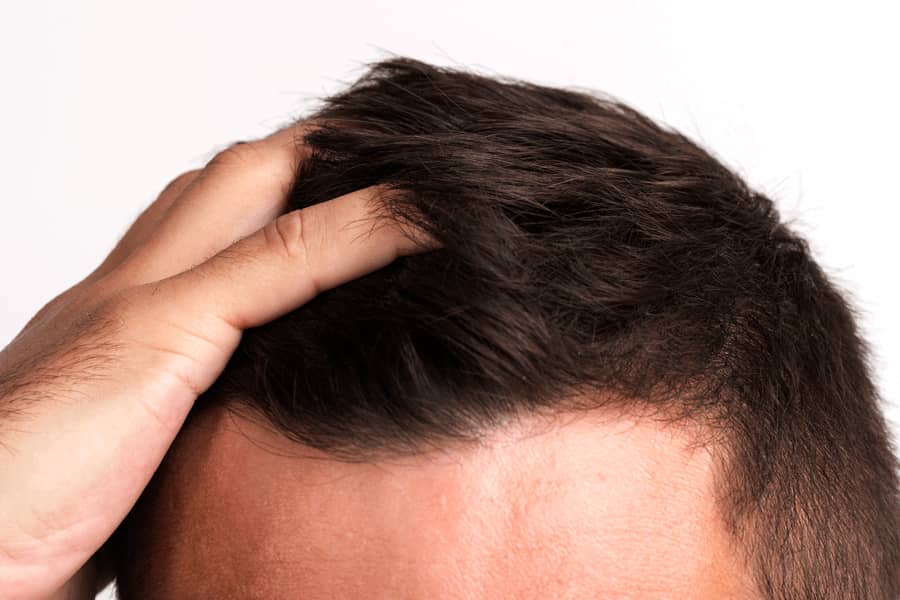 Benefits of Hair Transplant Surgery