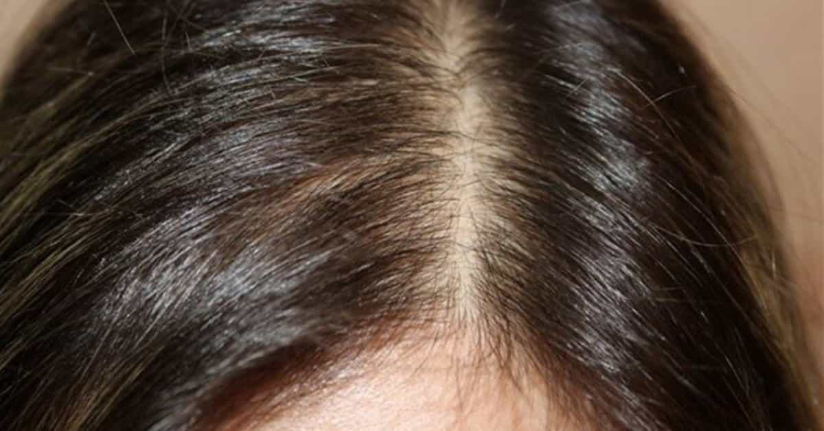 Hair Thinning Solutions in Men and Women