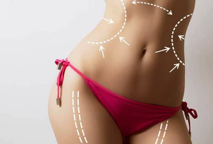 Medical Benefits of Liposuction Surgery