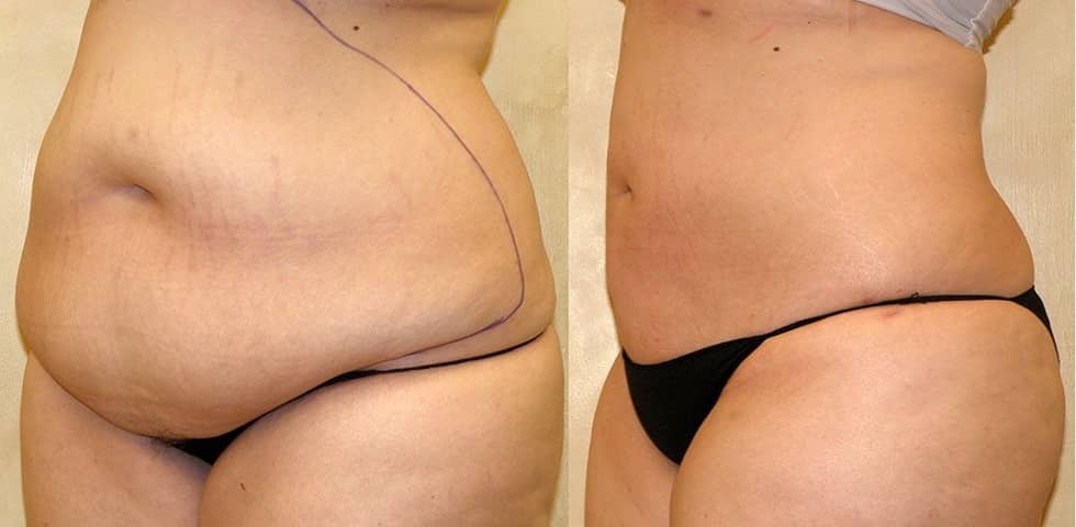 How Long Does a Liposuction Surgery Last