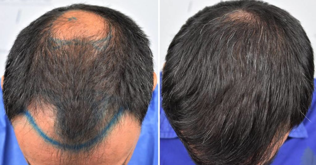 Do I Really Need A Hair Transplant?