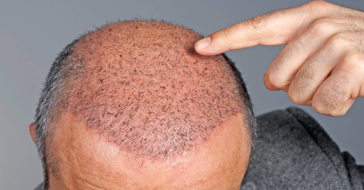 Hair Transplant Growth Timeline