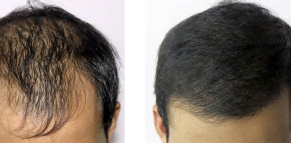 How Long After Hair Transplant Can I Lift Weights